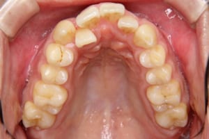 右上の側切歯が口蓋側転位しています